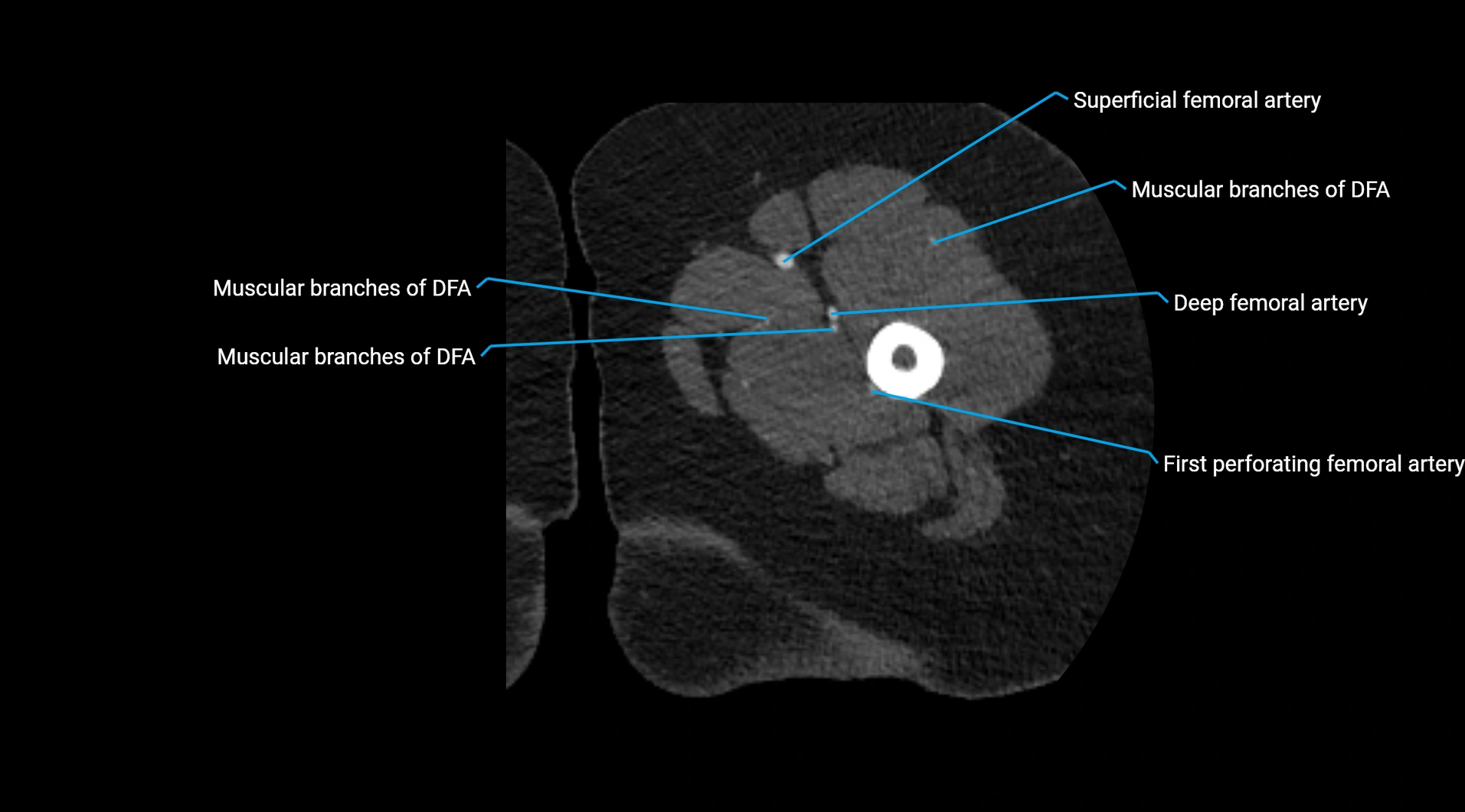 CTA lower limb cross sectional anatomy labelled image _99.webp